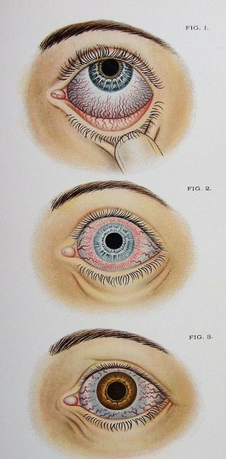 Diseases Of The Eye 1902 Ophthalmology Medical Textbook