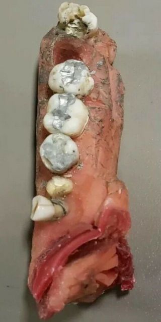Vintage Dental Practice Piece With 5 Real Human Teeth