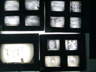 4 Vtg Magic Lantern Slides Xray Dental School C1930s Human Medical Abnormalities