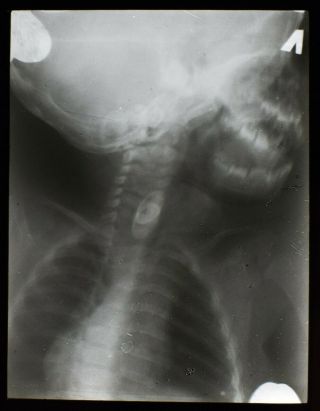 Vtg Magic Lantern Slide Xray Swallowed Object No4 C1947 Human Medical Photo